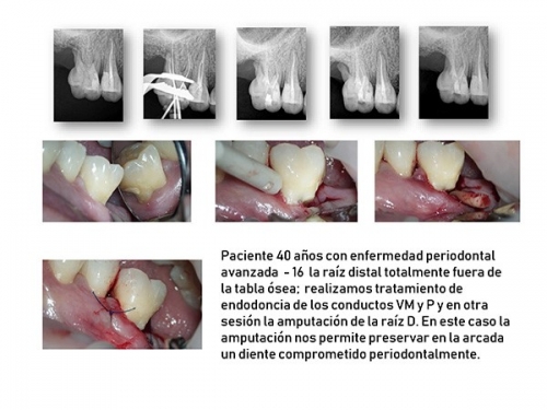 Amputación radicular