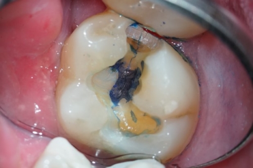 El diente fisurado . Diagnóstico y tratamiento 